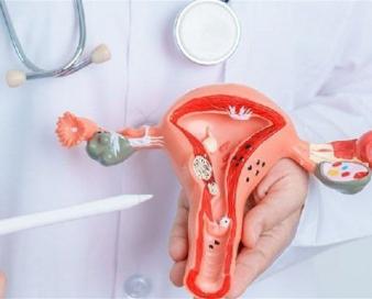 یک زن از هر 10 نفر دچار آندومتریوز میشود